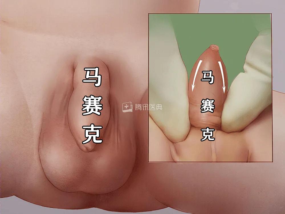 割吗?割啊!我在割包皮的医院走廊,唱完整首孤勇者