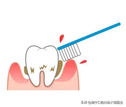 怎么治牙周病最好特别有效,牙医教你如何医牙