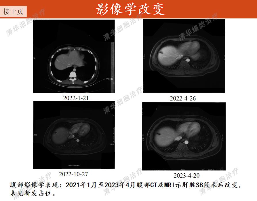结肠癌术后化疗方案的制定策略,结肠癌手术后热灌注化疗能根治吗