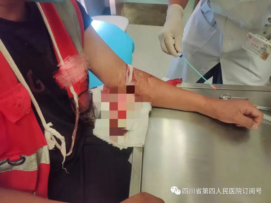 胳膊被锯断手术接上后多久恢复,肘部神经断裂恢复的案例