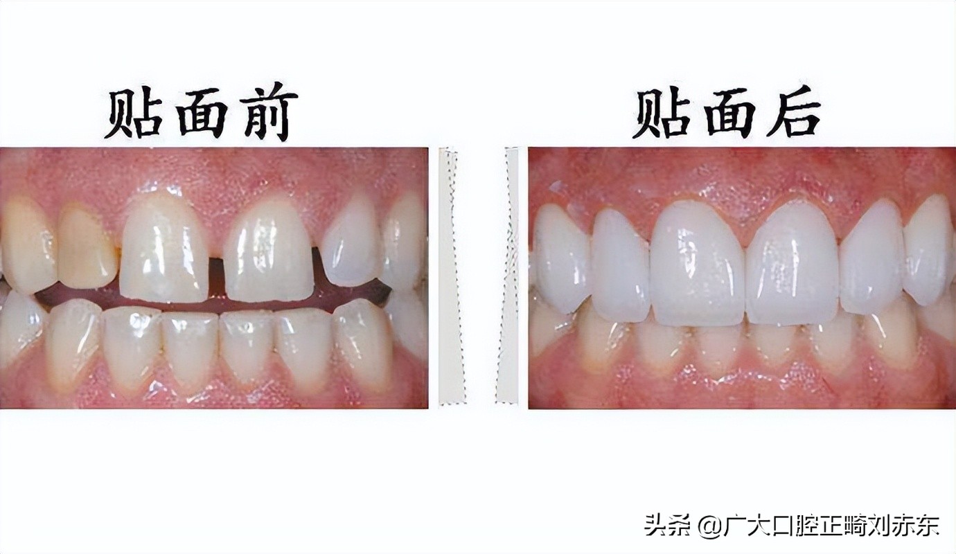 牙齿发黄变白用什么牙膏,牙齿发黄有牙垢怎么可以变白