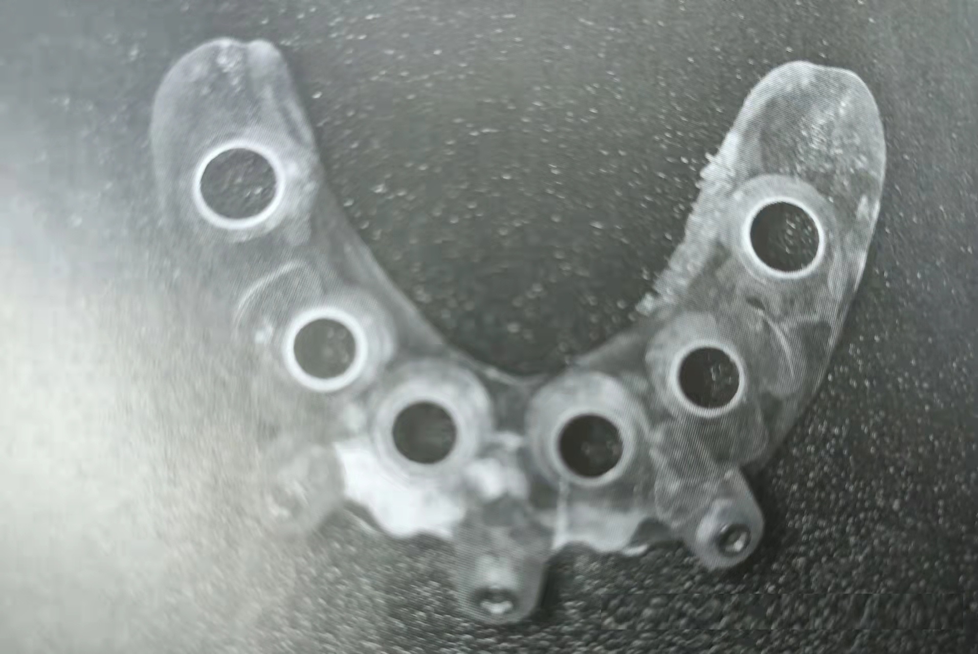 数字化导板微创种植牙,数字化3d导航种植牙