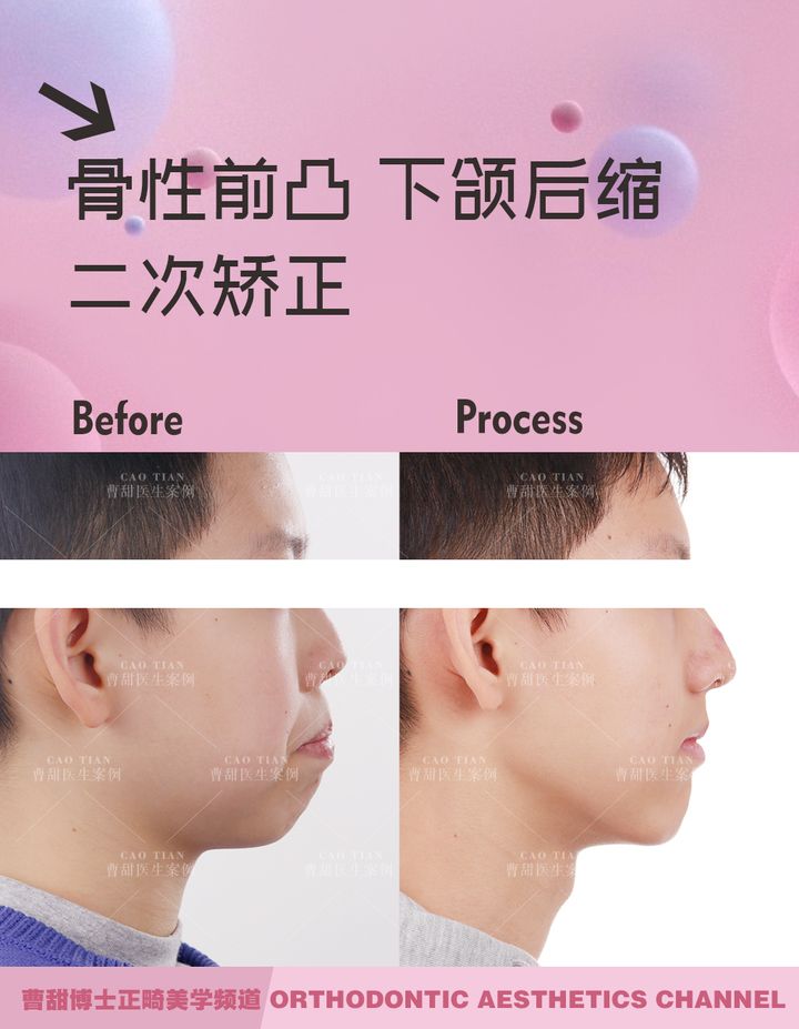 不拔牙矫正嘴凸下巴后缩案例,嘴瘪不拔牙矫正嘴会凸怎么办