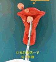 不同的子宫肌瘤都长啥样？看医生如何切除