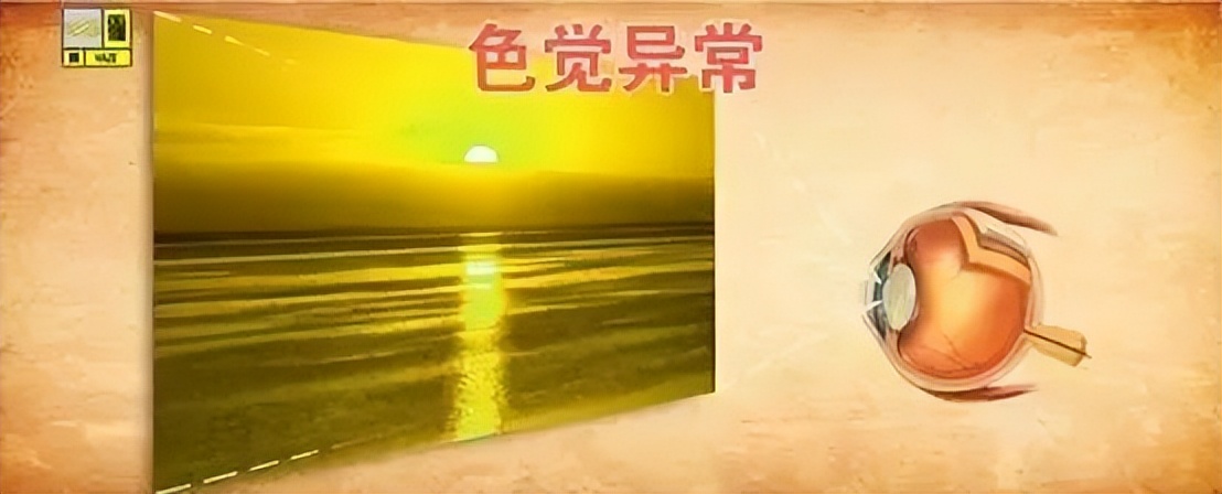 警惕四种致盲眼疾,中老年人要预防这些致盲性眼疾