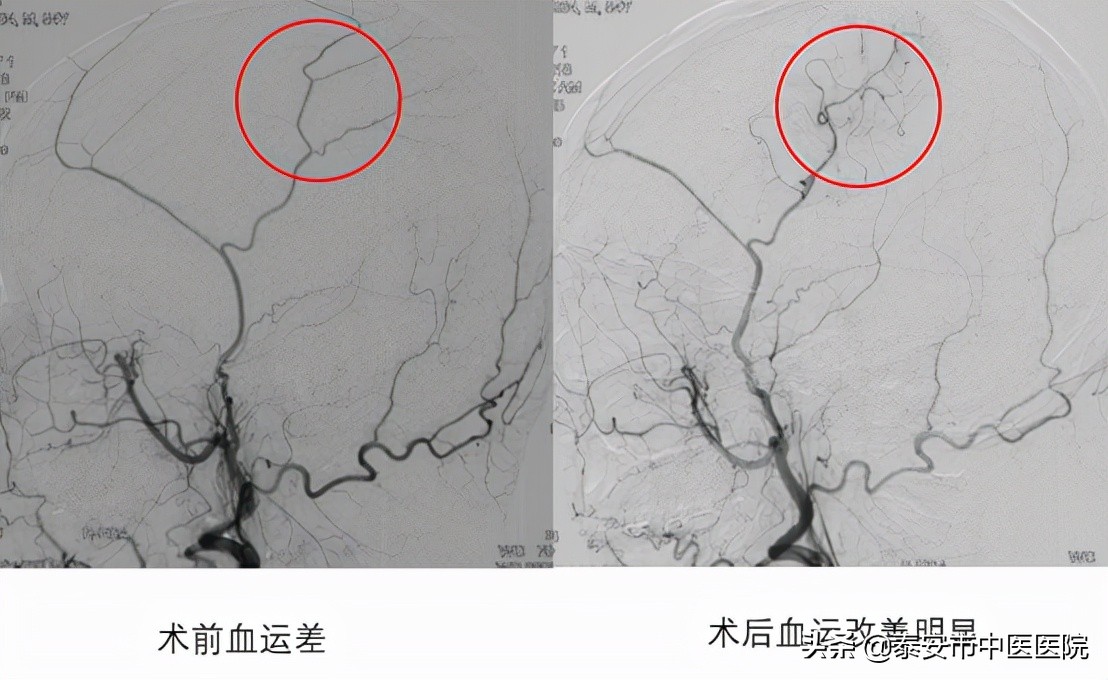 硬核技术!*安泰**市中医医院成功完成本院首例颅内外血管搭桥手术