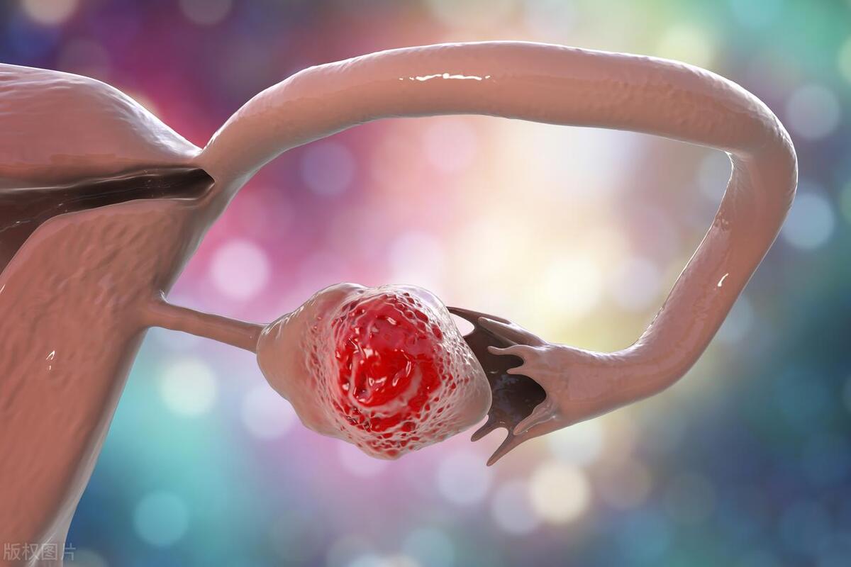 卵巢癌晚期有三个早期表现,卵巢癌一发现就是晚期