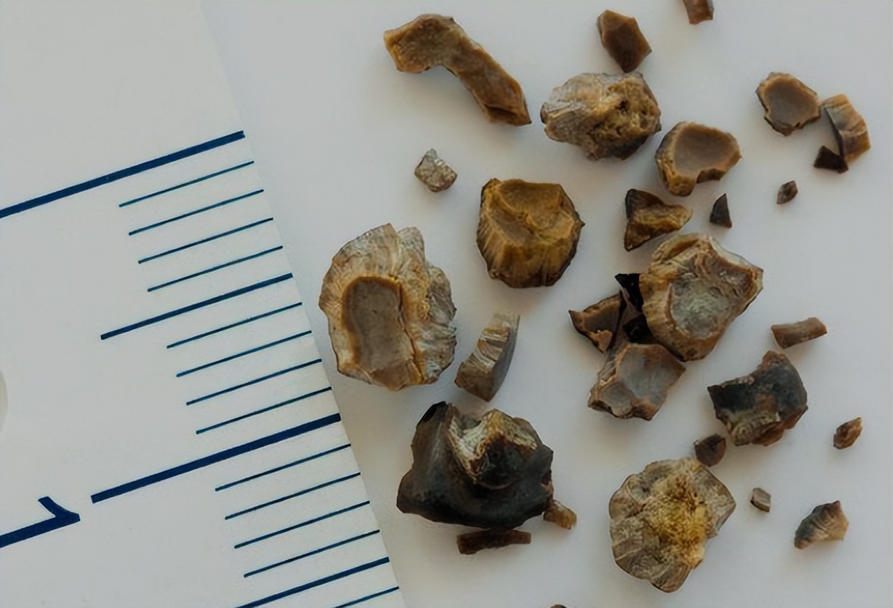 结石的治疗方法和饮食,结石可以通过吃什么缓解