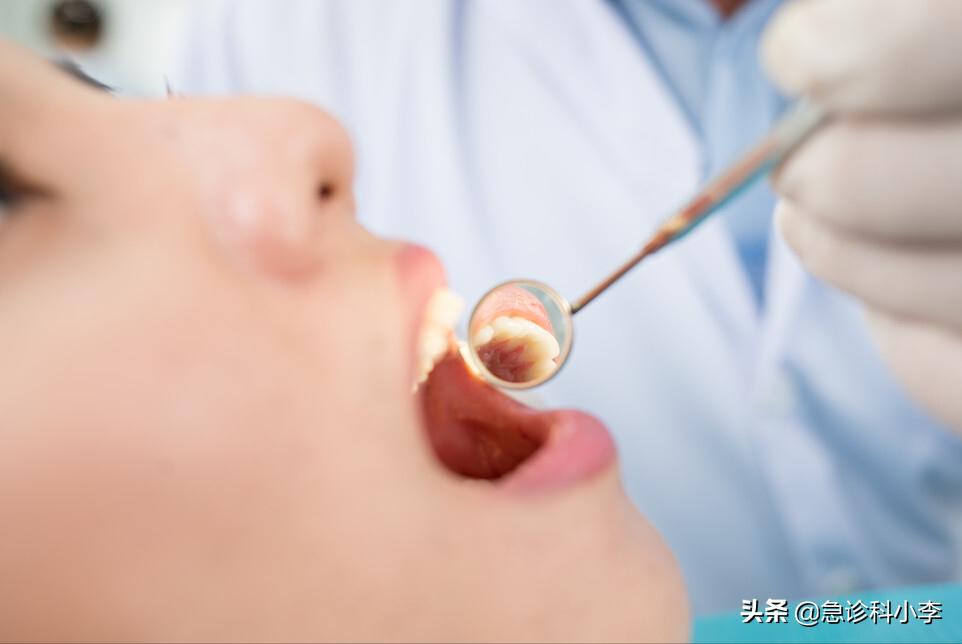 在牙缝里的牙结石要怎么去除,牙缝的牙结石怎么自己去除