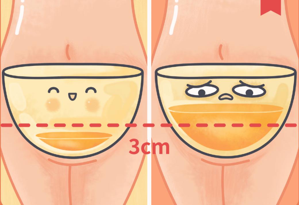 妇科医生说盆腔积液是什么意思,盆腔积液医生说有点盆腔炎严重吗