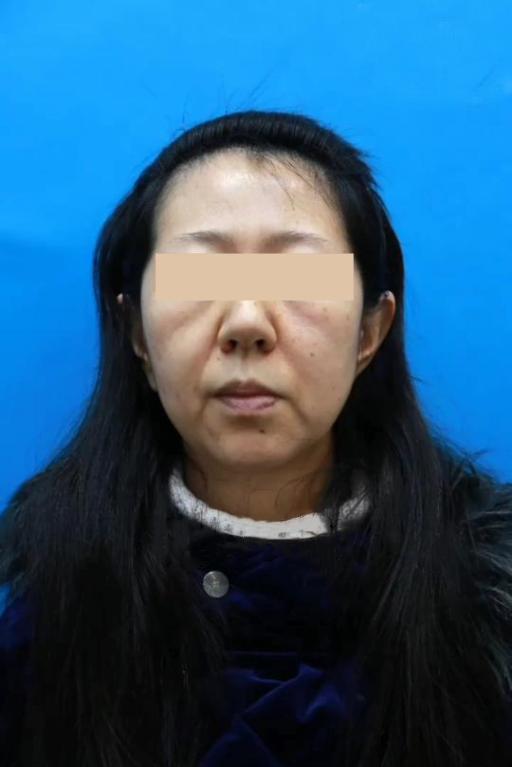 轮廓线打造和吸脂,面部轮廓线吸脂