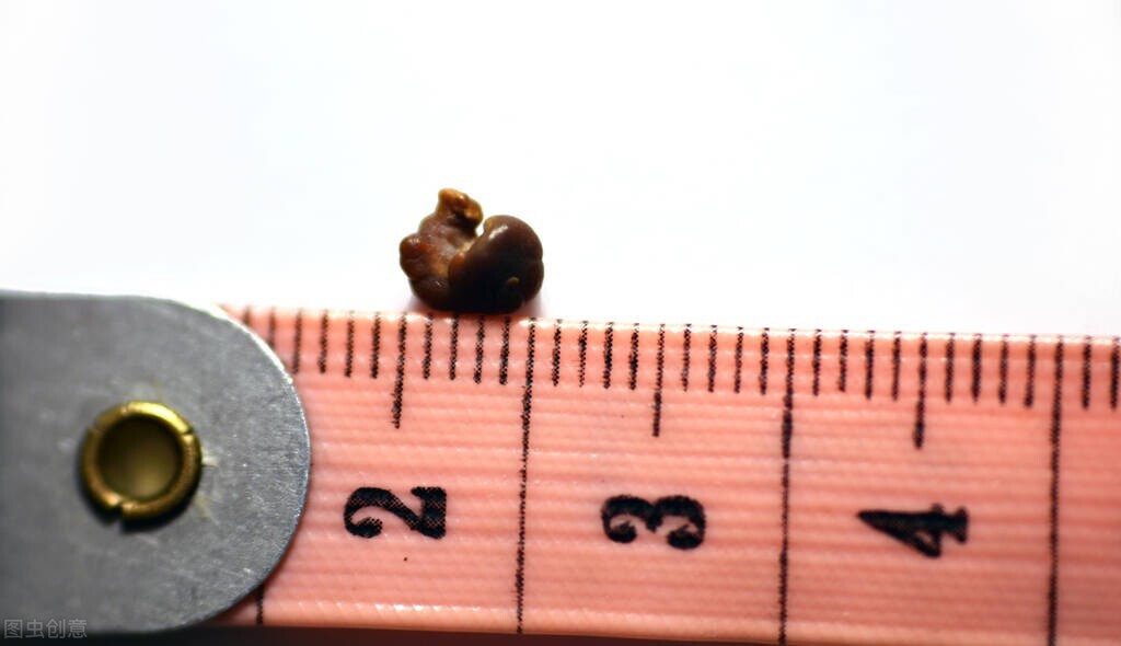 肾结石治不干净,慢性肾结石有什么偏方