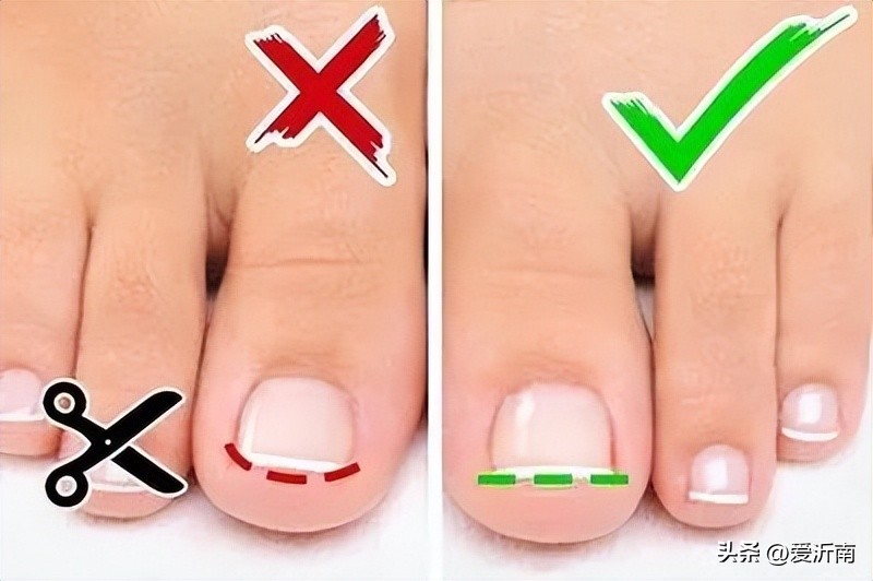 脚趾甲沟炎肿了涂什么药膏,小孩脚趾甲沟炎又红又肿怎样治疗