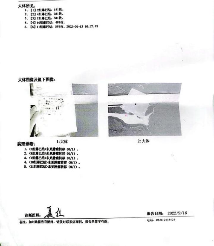 肺癌手术后什么时候能彻底恢复,肺癌手术后什么方法减轻病人痛苦