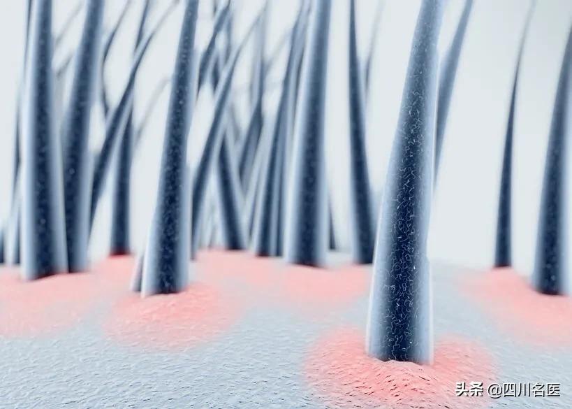 头屑越来越多是脱发的表现吗,头屑过多别忽视竟还暗藏脱发危机