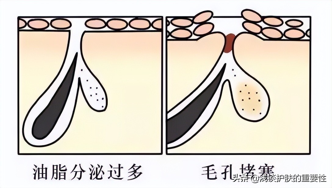 毛孔粗大收缩毛孔最有效果的方法,毛孔粗大收缩毛孔最快有效的方法