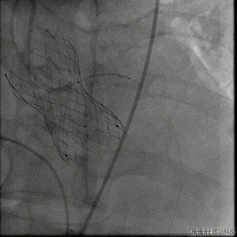 病例回顾与分享,腹膜后血肿介入治疗