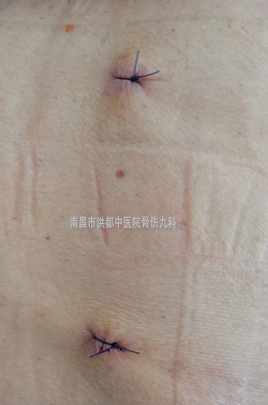 打个喷嚏导致腰椎骨折视频,打个喷嚏全身骨折视频