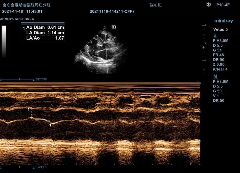 二尖瓣发育不良病例总结