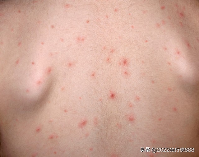 幼儿手脚心发热是什么原因,幼儿间断性发热是怎么回事