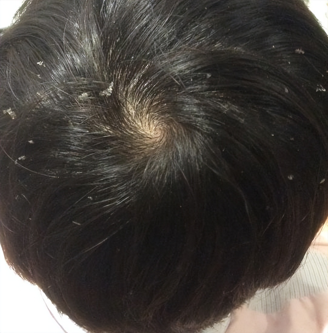 头皮上老是长脓包怎么回事,头皮上总是长疙瘩和脓包如何根治