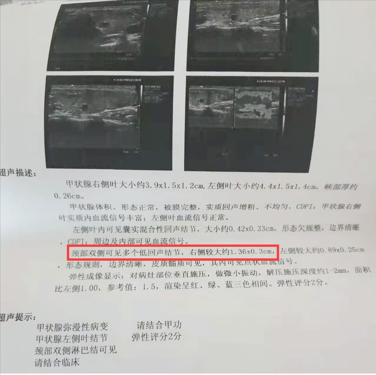 名老中医治肝郁气滞型甲状腺结节,莆田市老中医治疗甲状腺结节