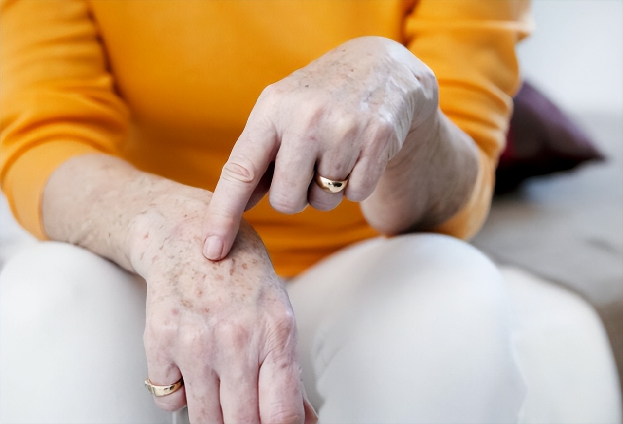 红霉素眼膏能治老年斑,红霉素软膏为什么不能消除老年斑