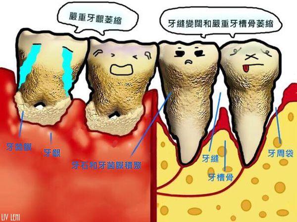 为什么洗完牙后牙缝会变大,牙医说洗牙后牙缝变大