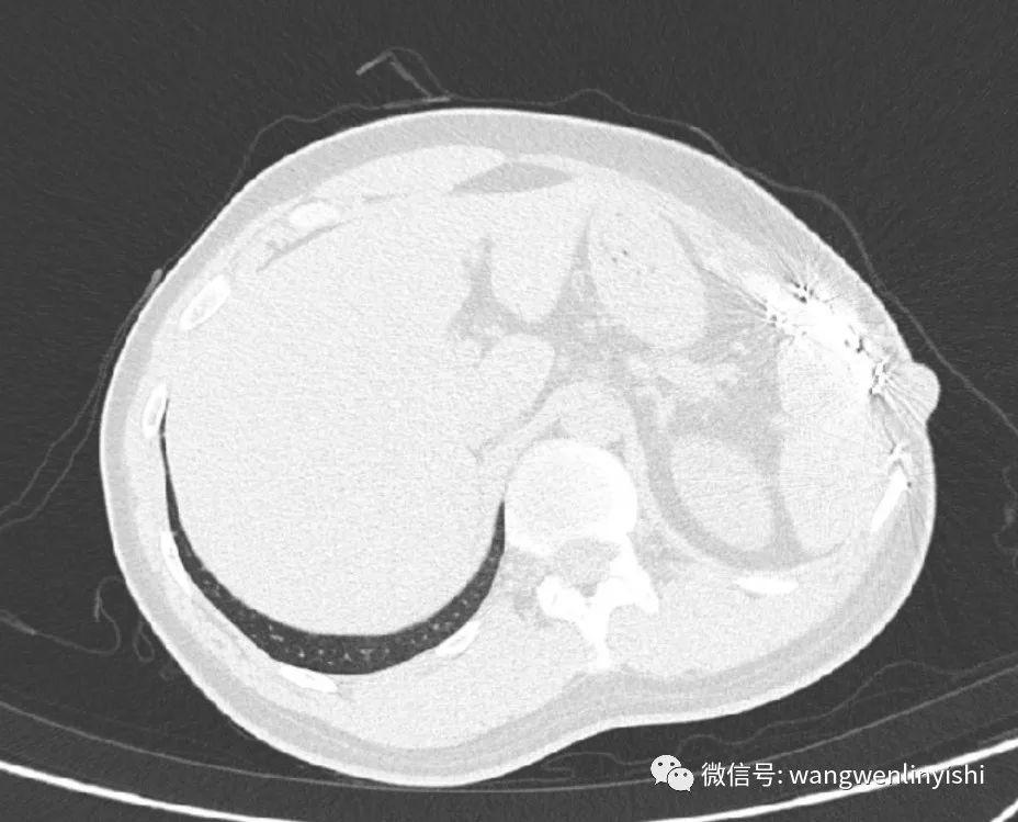 胸壁转移癌已切除癌症会扩散吗,胸壁转移瘤复发可以二次手术吗