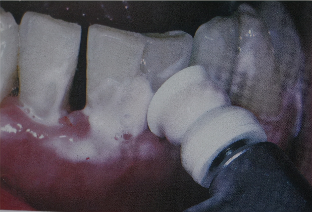 洗牙之后疼怎么办,洗牙疼不疼视频大全