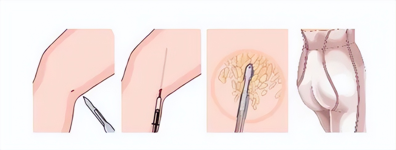 九院韦敏手术案例,九院整形科吸脂医生