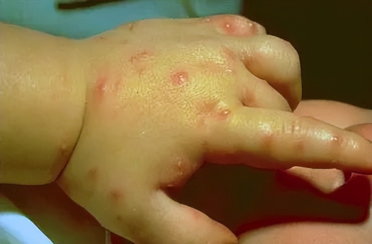 小宝宝出门怎么防护毒虫,带孩子出去玩当心这种虫子