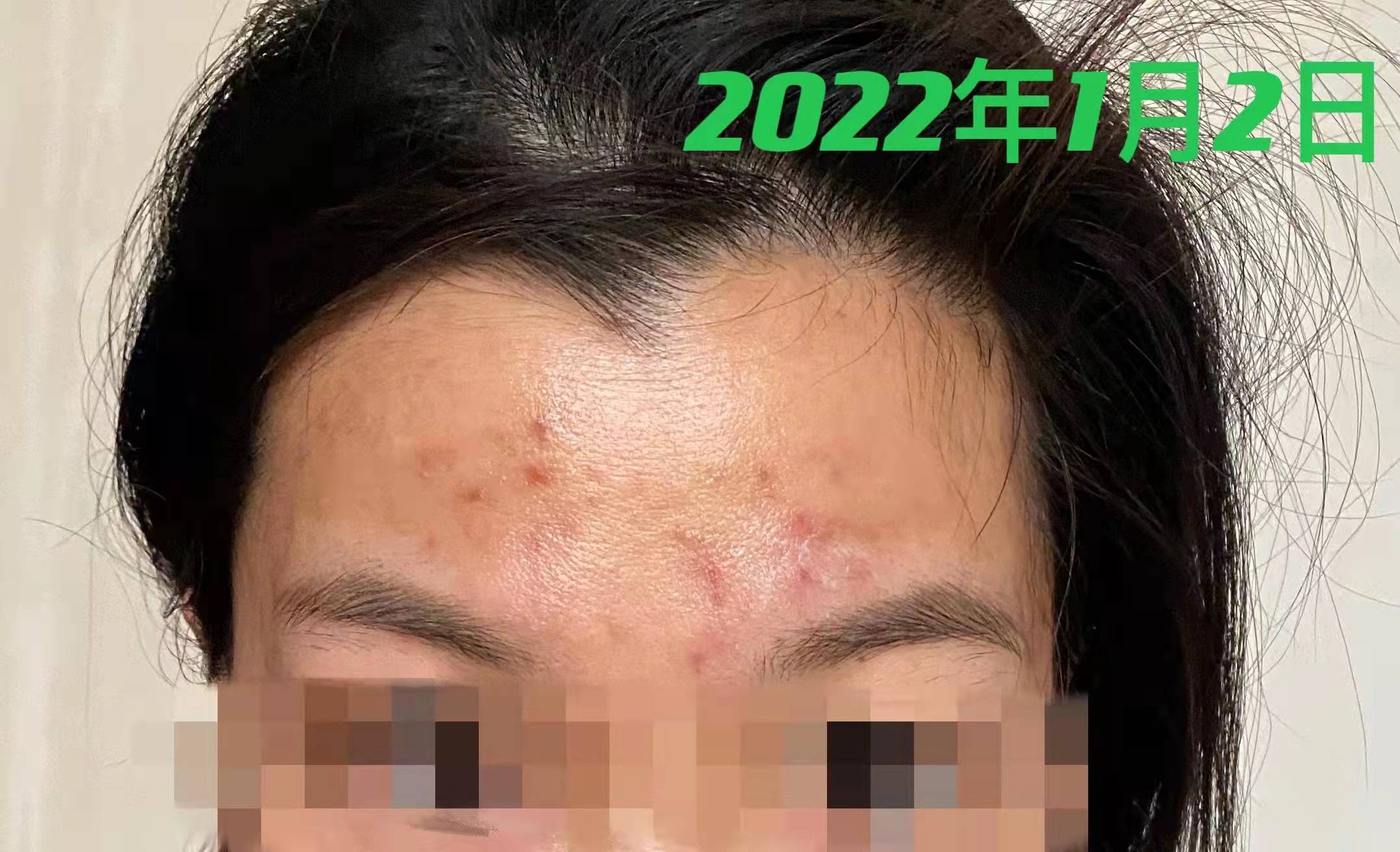 28岁女脸上反复长痘怎么办,28岁痘痘反复长是什么原因