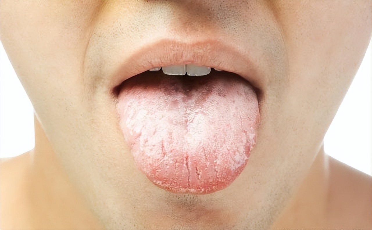 口干口苦牙龈肿痛中医辨证,内热牙龈肿喝什么降火