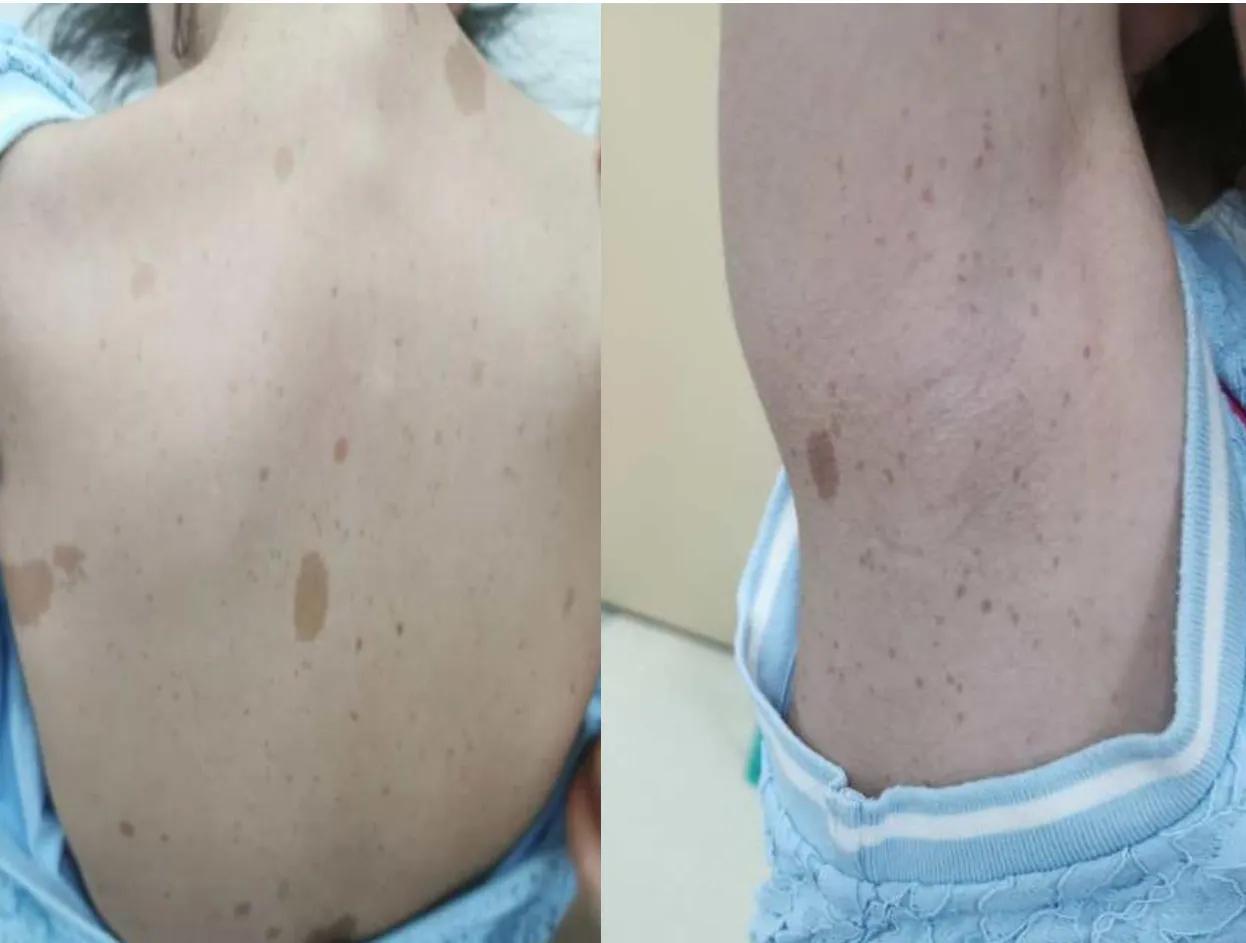 I型神经纤维瘤斑能淡化吗,i型神经纤维瘤胎记能治好吗