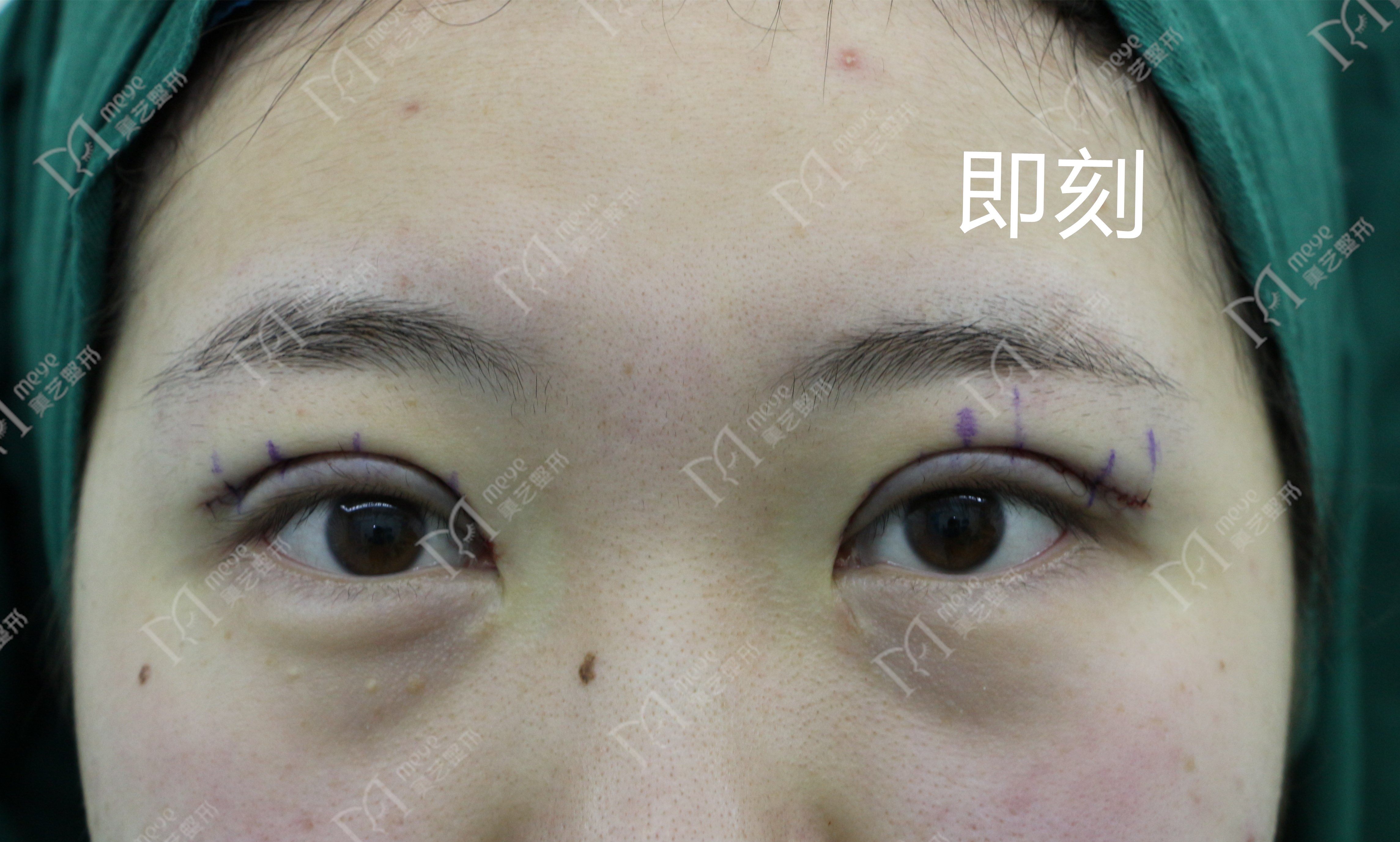 郑州修复双眼皮成功案例,郑州双眼皮修复全过程