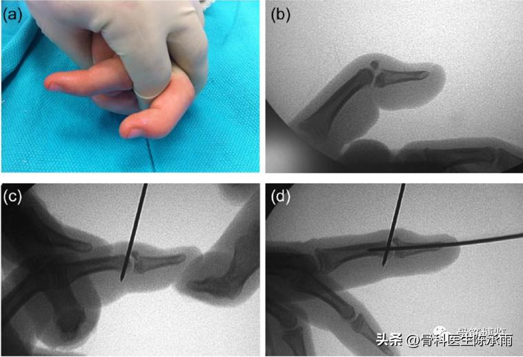 手指出现锤状畸形不要太紧张，看后知道伸肌腱止点断裂重建术