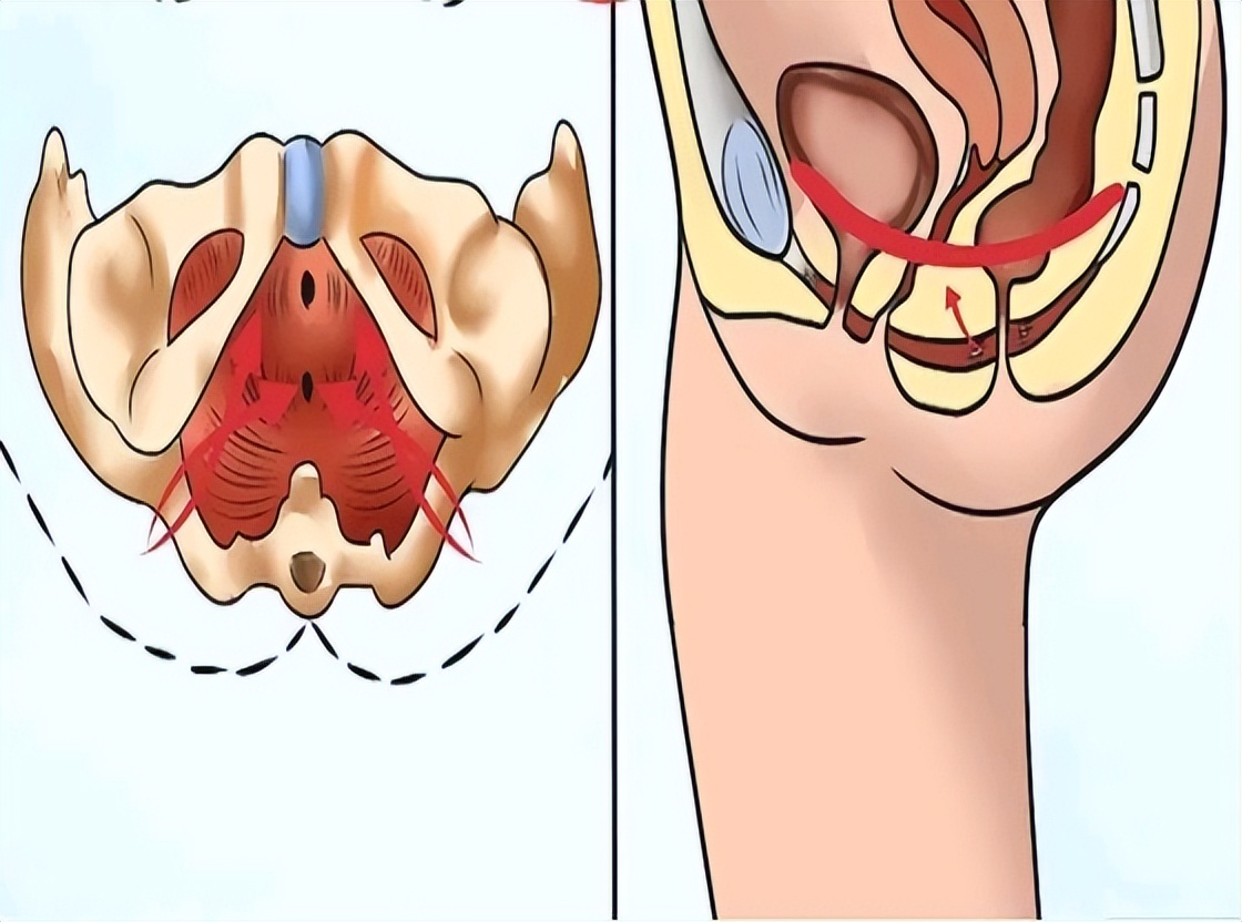 60岁女性盆底肌松弛漏尿如何治疗,老年盆底肌漏尿如何改善