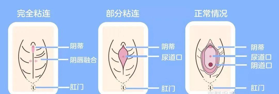 女童粘连最简单处理方法,女童粘连家长怎么护理