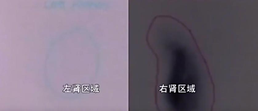 姑娘参加体检发现左肾丢失,左肾丢失的女孩最终结果