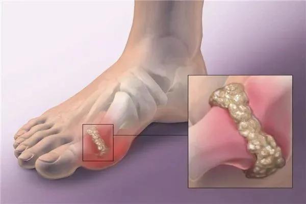 专家教你如何缓解痛风,一招治痛风