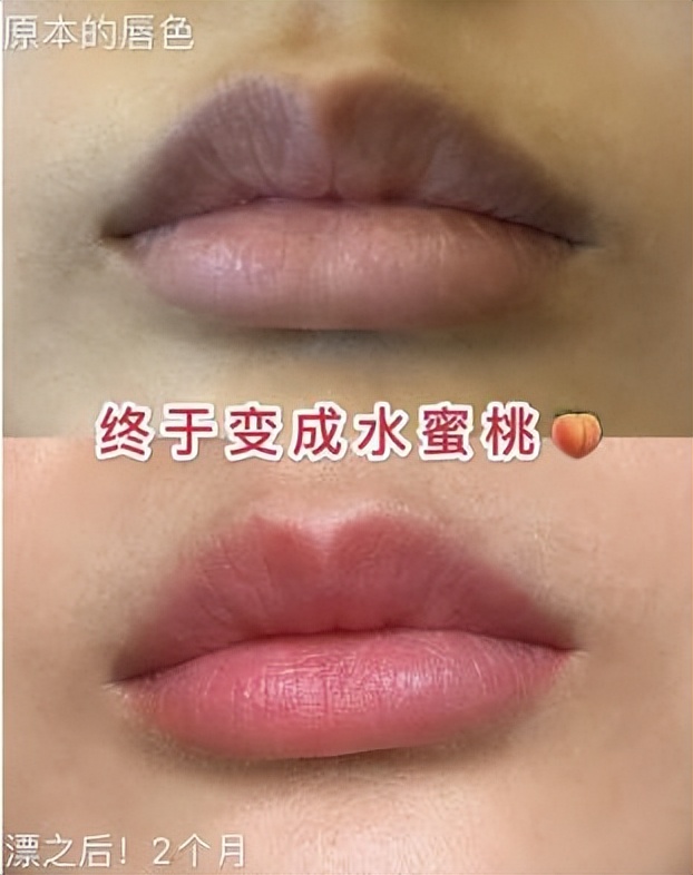 塑颜工匠嘴唇团购,塑颜工匠后续