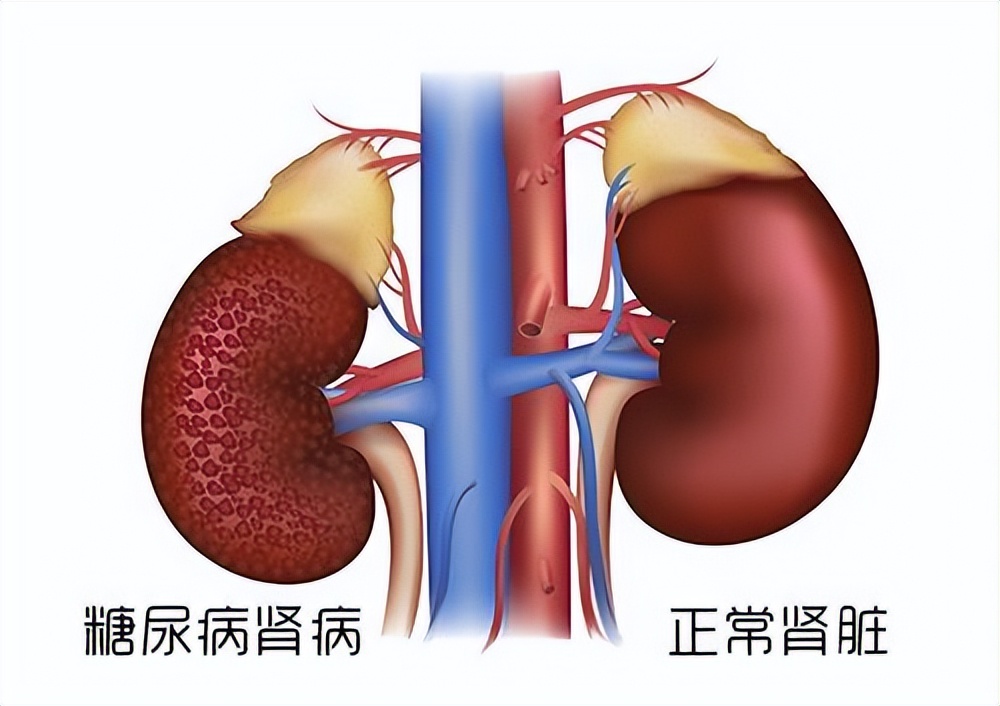 血糖糖化控制在6,血糖控制在多少糖化才会达标