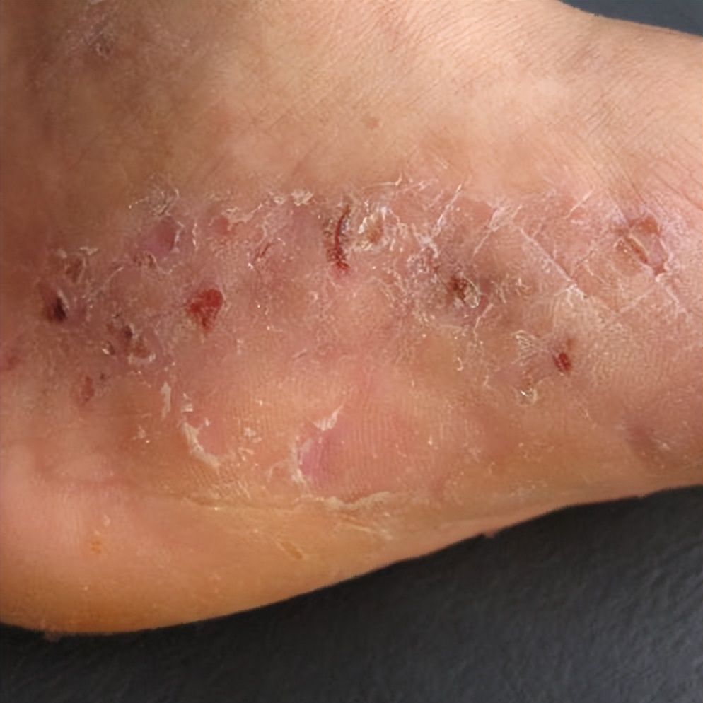 水上乐园妇科传染病案例,去完水上乐园怎么防止得妇科病