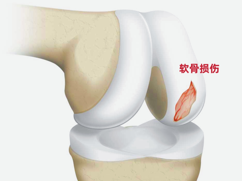 膝盖关节软骨疼痛怎么办,膝关节软骨疼痛的症状
