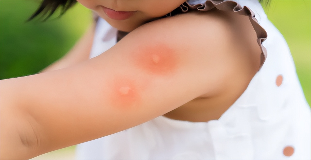 被蚊虫叮咬会痒怎样解决,为什么被蚊虫咬了会痒好几天