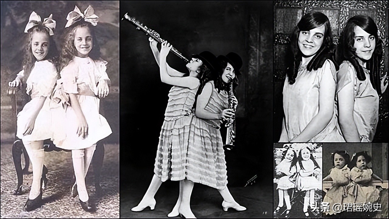 英国连体双胞胎姐妹,英国连体姐妹