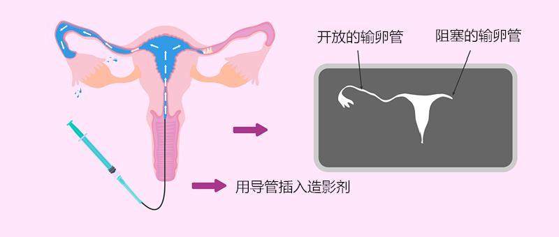 关于输卵管造影的三个问题,女性做输卵管造影怎么做