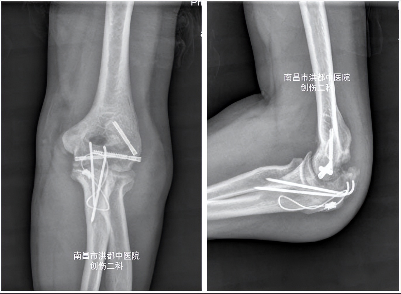 肘关节骨折僵硬康复训练后肿了,肘关节骨折后僵硬的原因