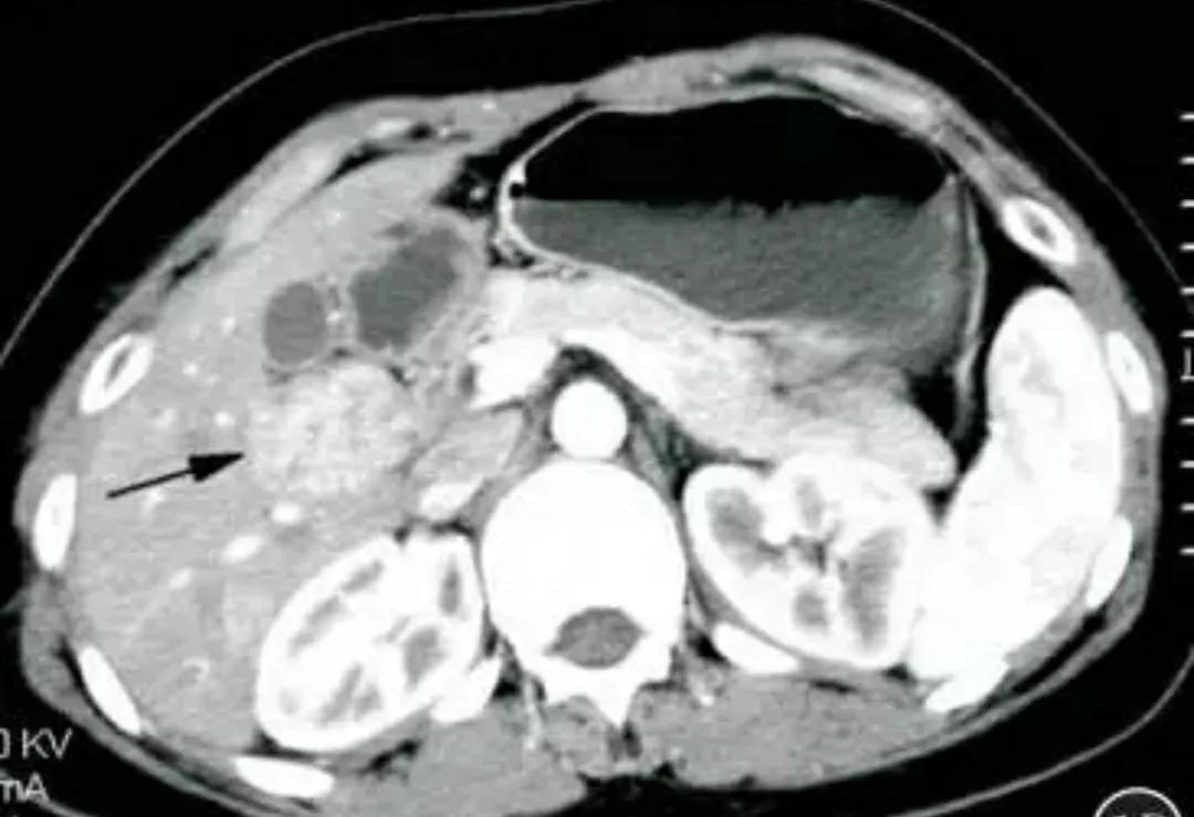 肝内血管瘤和肝癌超声怎么区分,肝占位病理检测项目